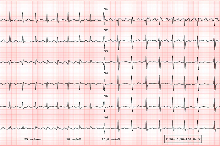 flutter atrial